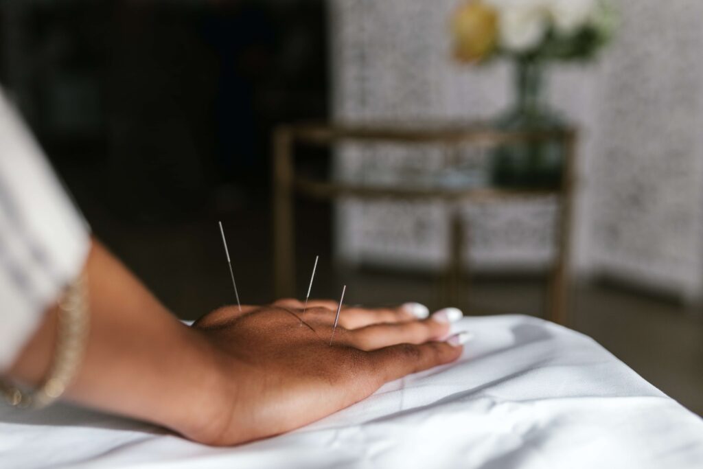 Médecine traditionnelle chinoise : L'acupuncture